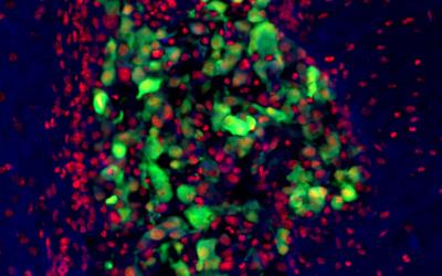 Human glioblastoma in mouse