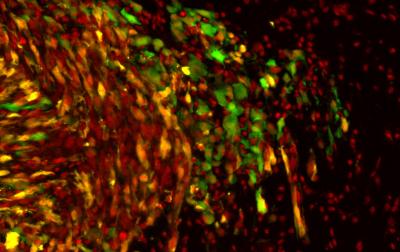 Human glioblastoma derived tumor in mouse brain